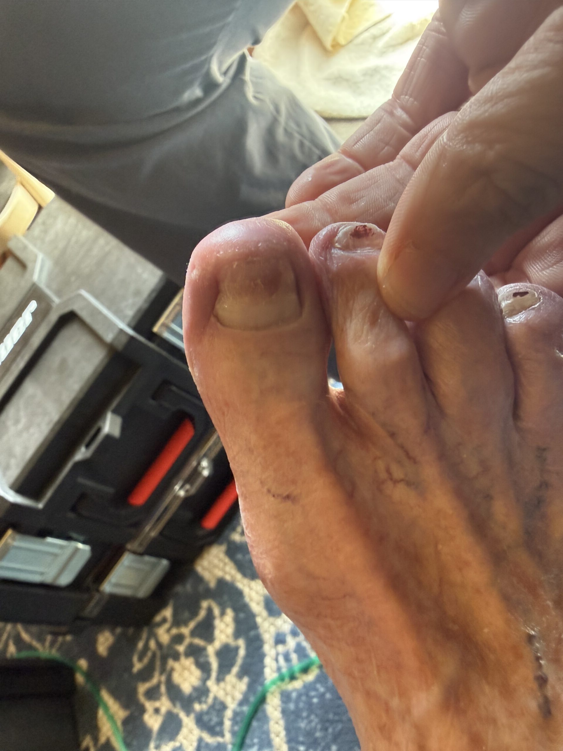foot wound care