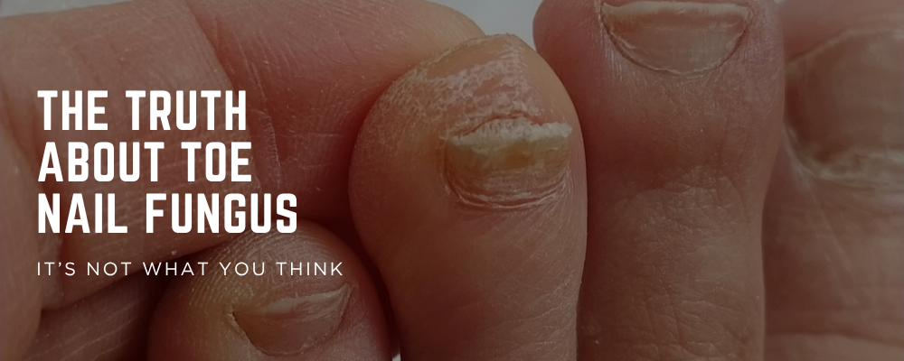 The Truth About Toenail Fungus: It’s Not What You Think
