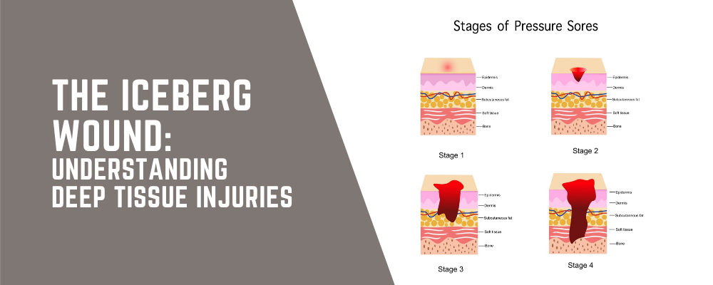 The “Iceberg” Wound: Understanding Deep Tissue Injuries 