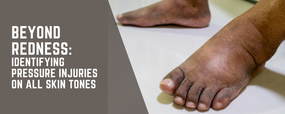 Beyond Redness: Identifying Pressure Injuries on All Skin Tones