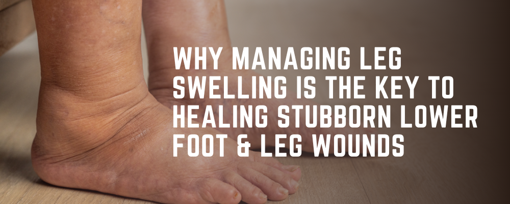leg swelling